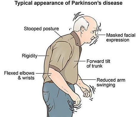 MOVEMENT DISORDERS