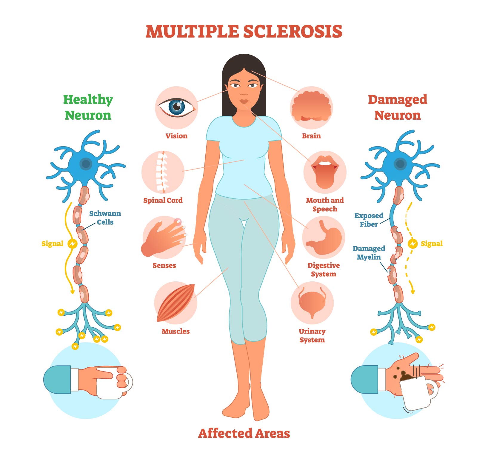 NEUROIMMUNOLOGY INCLUDING MS